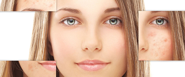 препарати для акне 1